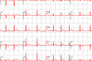Electrocardiogram red graph pattern