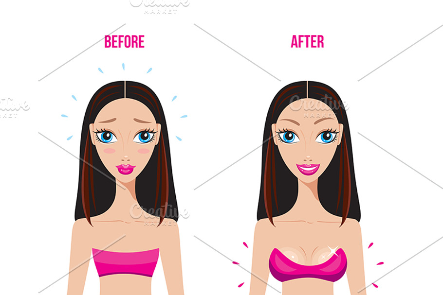Breast augmentation Before & After in Illustrations - product preview 8