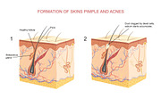 Formation of skins pimple and acnes
