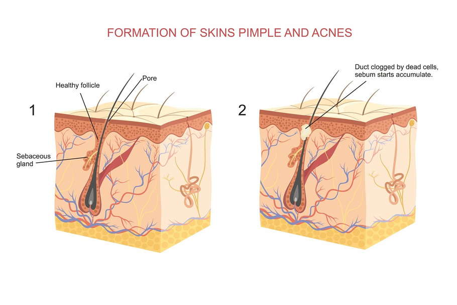 Formation of skins pimple and acnes in Illustrations - product preview 8