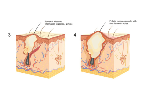Formation of skins pimple and acnes in Illustrations - product preview 1