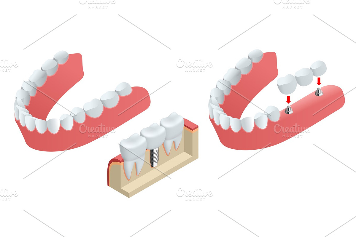 Isometric Tooth human implant. Dental concept. Human teeth or dentures. 3d illustration Isolated on white Realistic vector illustration in Objects - product preview 8