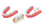 Isometric Tooth human implant. Dental concept. Human teeth or dentures. 3d illustration Isolated on white Realistic vector illustration
