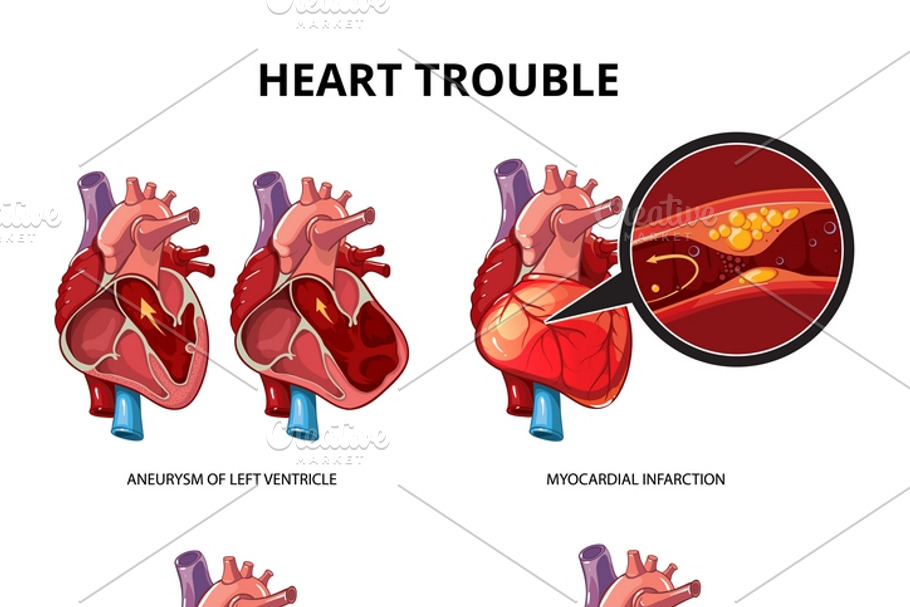 Heart disease vector infographics