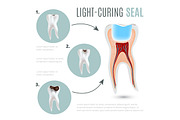 Caries and light-curing seal poster