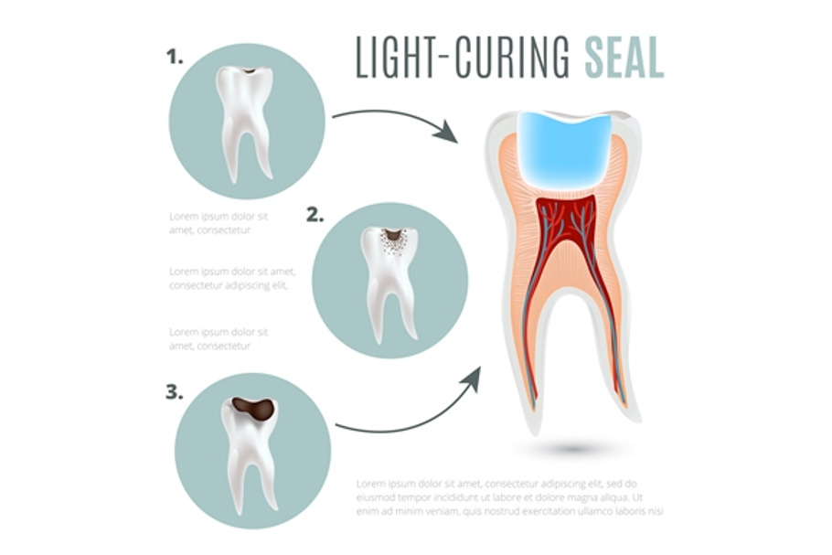Caries and light-curing seal poster in Illustrations - product preview 8