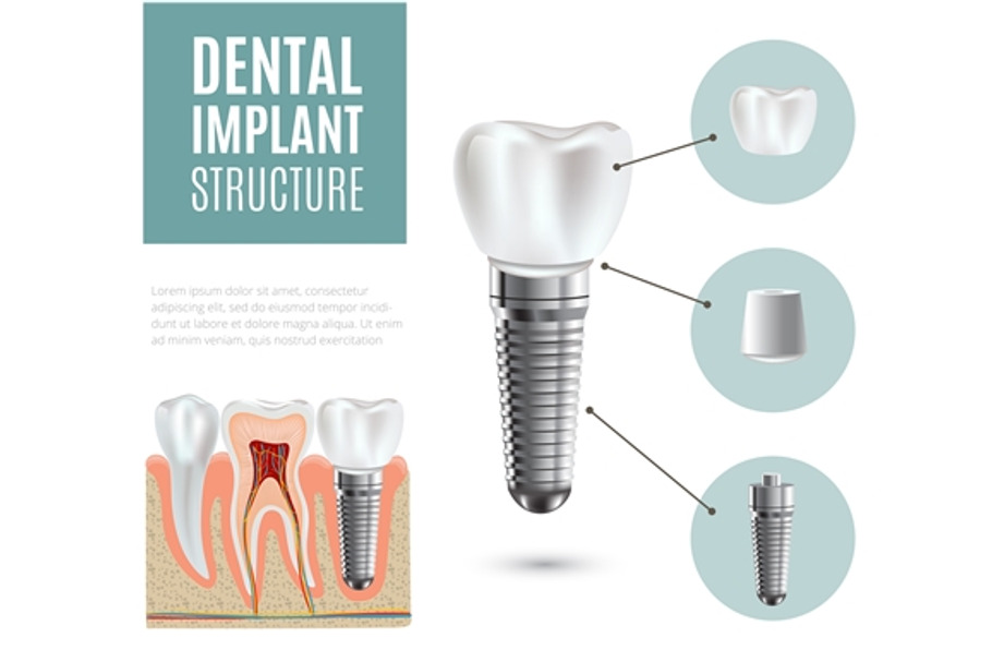 Dental implant structure poster in Illustrations - product preview 8