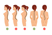 Types of curvature of the spine