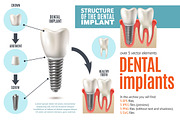 Dental Implants Set
