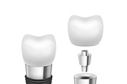Metal disassembled tooth implant