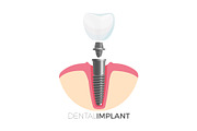 Dental implant tooth and screw on vector illustration
