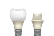 Plastic assembled tooth implant