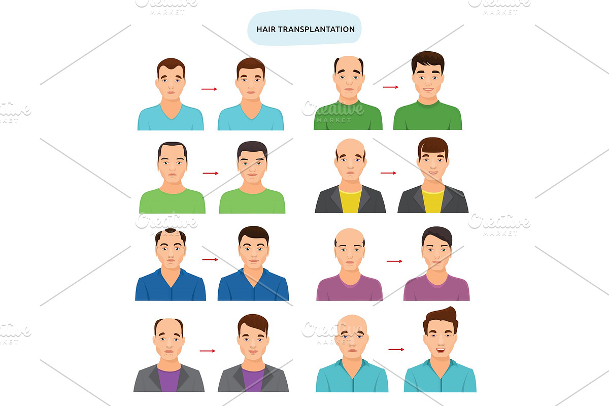 Hair transplant vector hairy transplantation after hairloss and baldness for bald man illustration set of hairless male character and haired person with haircat isolated on white background in Illustrations - product preview 8