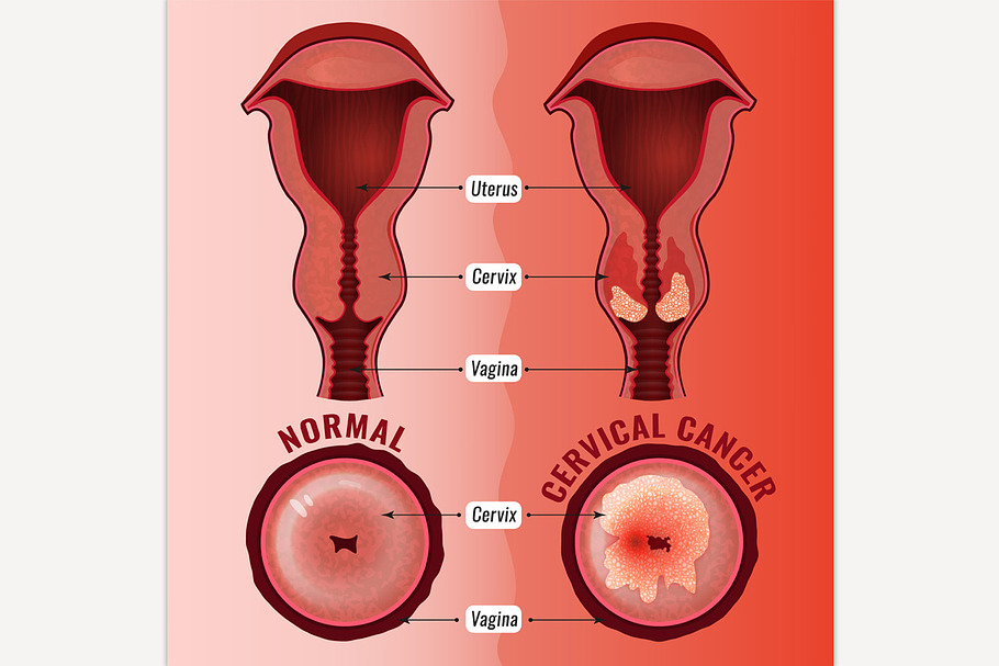 Cervical Cancer Image
