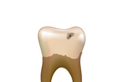 Old sick human tooth with caries