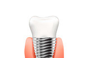 Tooth implant with metallic screw
