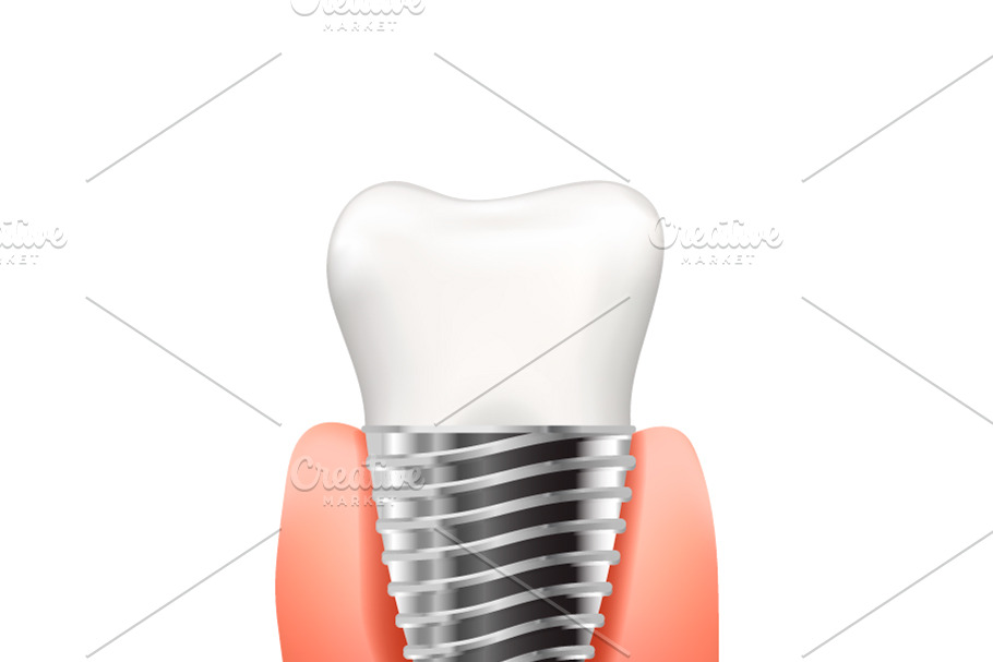 Tooth implant with metallic screw in Objects - product preview 8