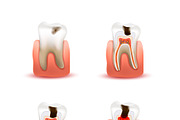 Four different caries stages