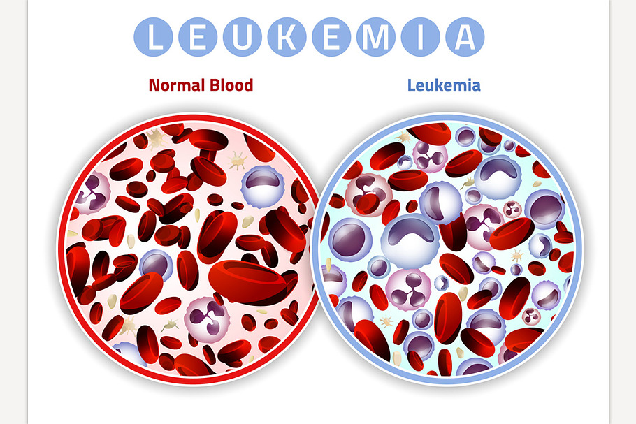 Leukemia Infographic Image in Illustrations - product preview 8