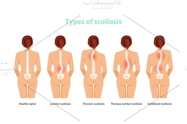 Types of scoliosis vector