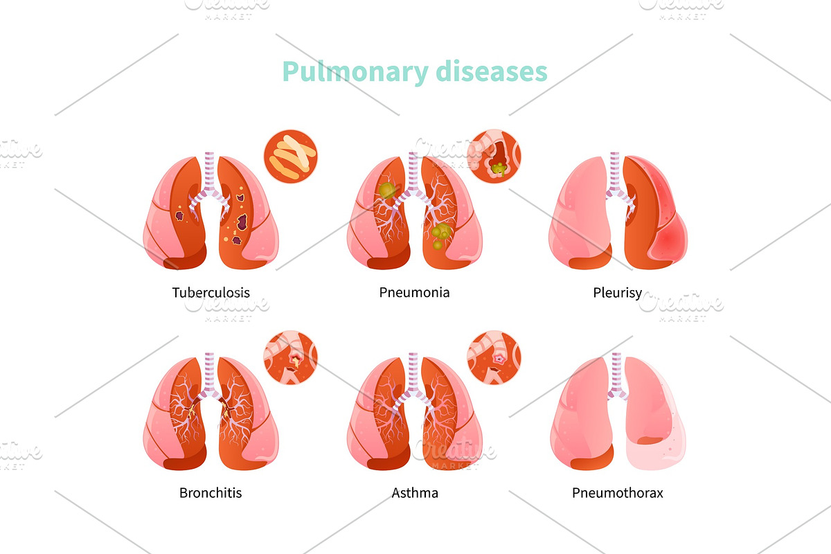 Pulmonary disease vector in Objects - product preview 8