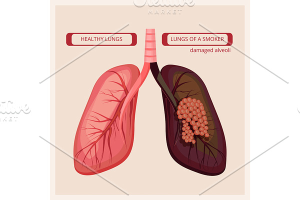 Smoker lungs. Smoke human damage