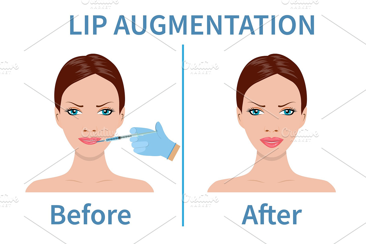 Lip augmentation with hyaluronic in Objects - product preview 8
