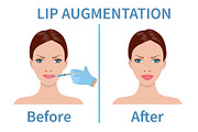 Lip augmentation with hyaluronic
