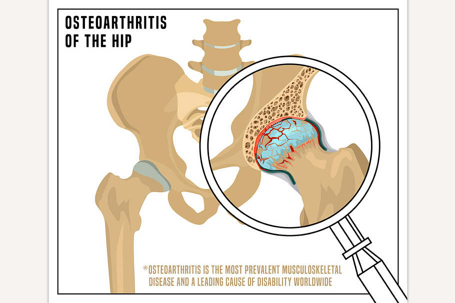 Hip Osteoarthritis Image in Icons - product preview 8