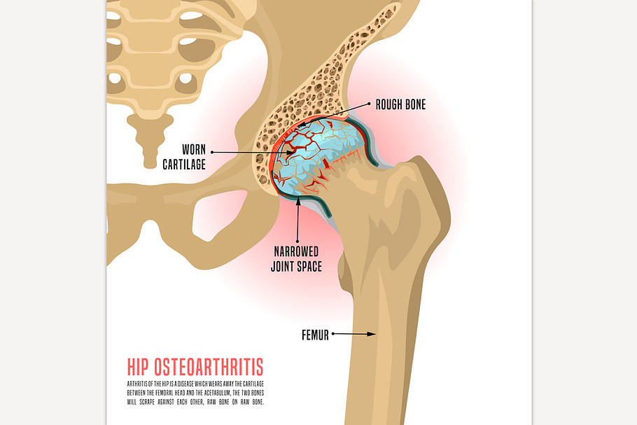 Hip Osteoarthritis Infographic in Icons - product preview 8