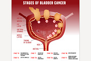 Bladder Cancer Image