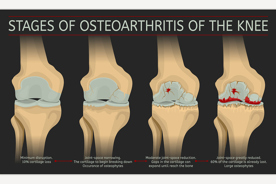 Stages of osteoarthritis of the knee in Illustrations - product preview 8