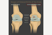 Stages of osteoarthritis of the knee