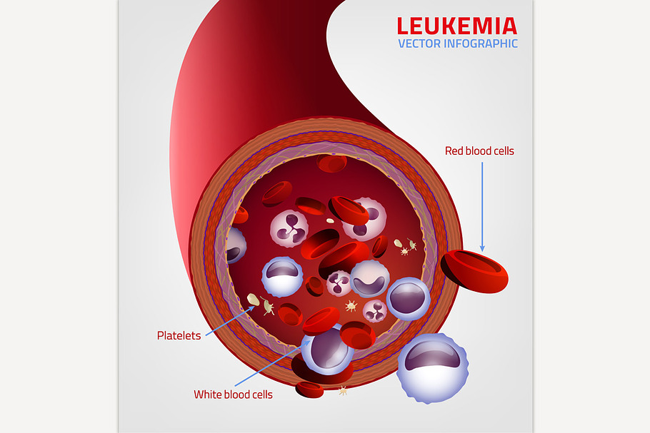 Leukemia medical infographic in Illustrations - product preview 8