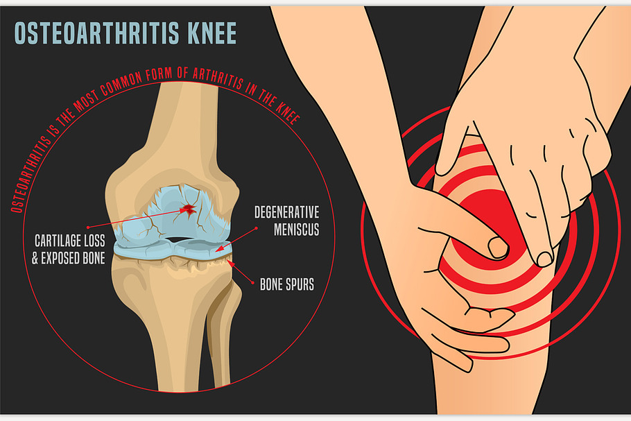 Osteoarthritis Knee Poster in Illustrations - product preview 8