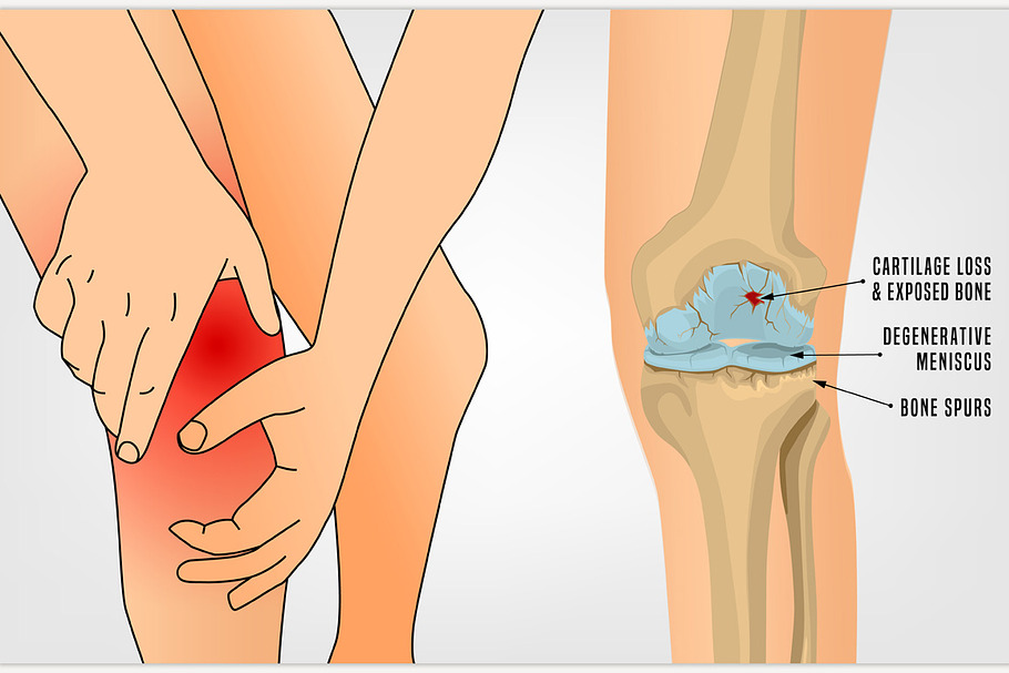 Osteoarthritis Knee Poster in Illustrations - product preview 8