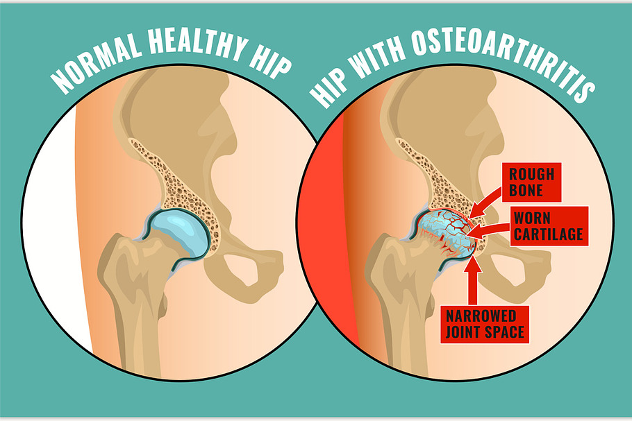 Hip Osteoarthritis Infographic