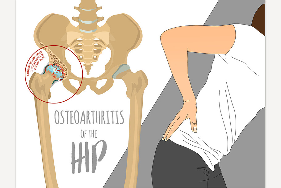 Hip Osteoarthritis Infographic