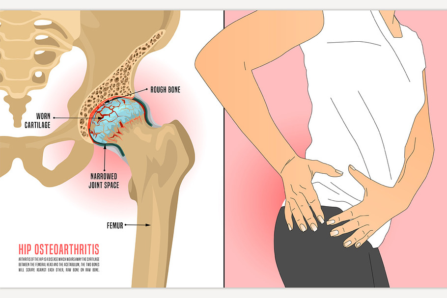 Hip Osteoarthritis Infographic in Illustrations - product preview 8