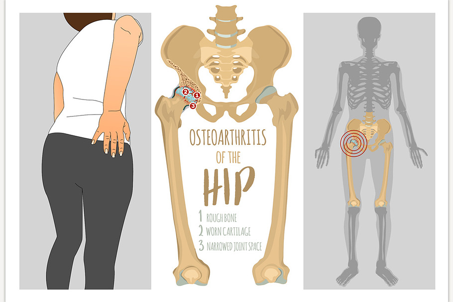 Hip Osteoarthritis Infographic in Illustrations - product preview 8