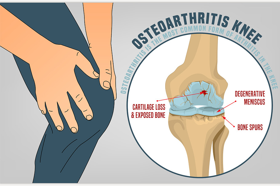 Osteoarthritis Knee Poster