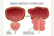 Prostate Disease Infographic
