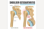 Shoulder osteoarthritis infographic