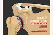 Shoulder arthritis infographic