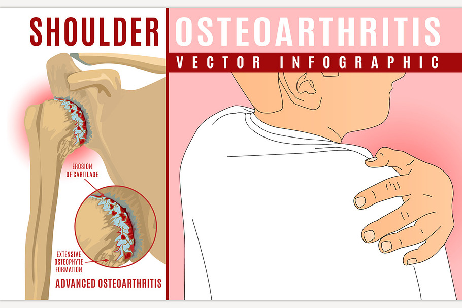 Shoulder osteoarthritis infographic. in Illustrations - product preview 8