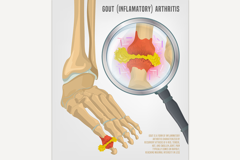 Gout arthritis image