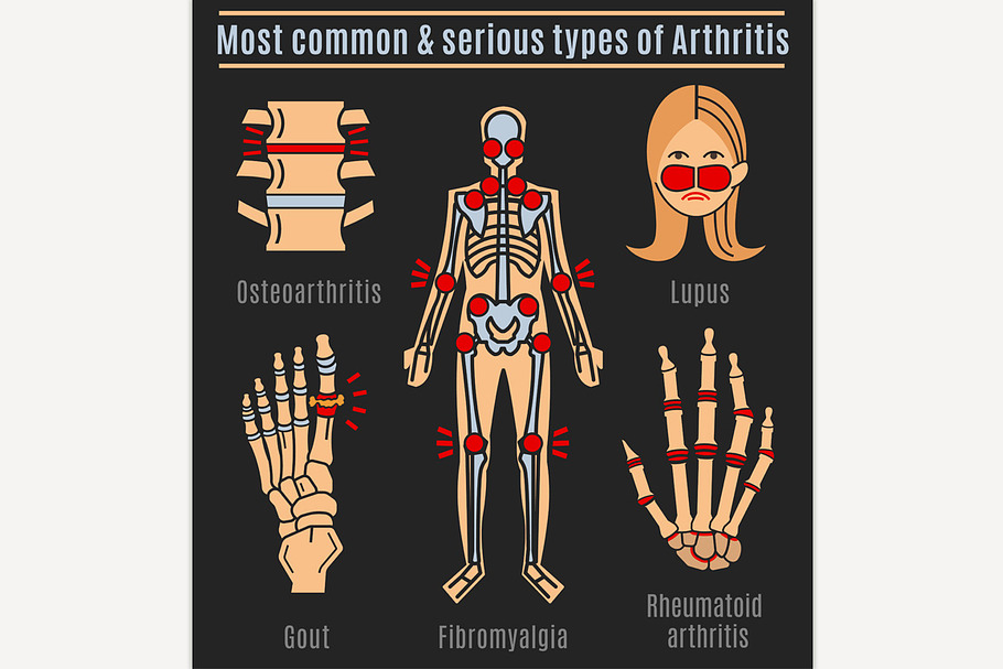 Arthritis types infographic