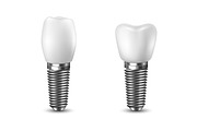 Tooth implant. Vector set.