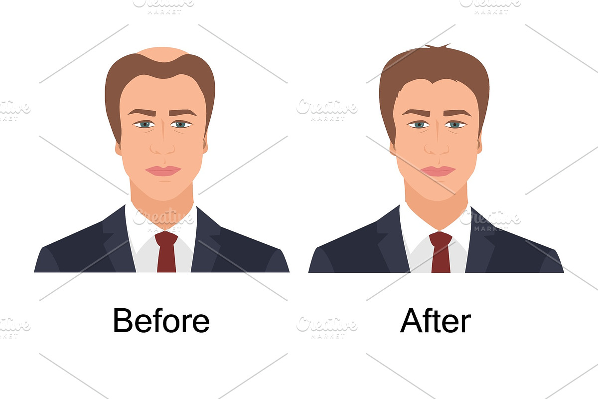 Man with alopecia before and after in Illustrations - product preview 8