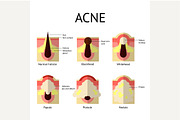 Types of acne pimples. Healthy skin
